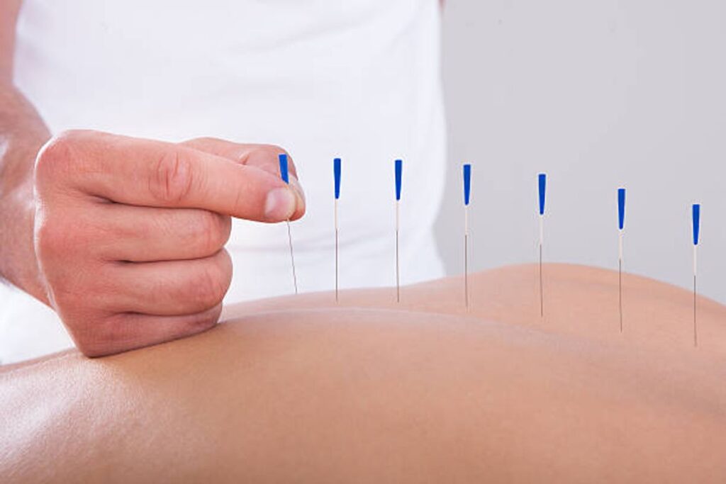 Acupuncture Clinic Near Me Find Out The Best Info