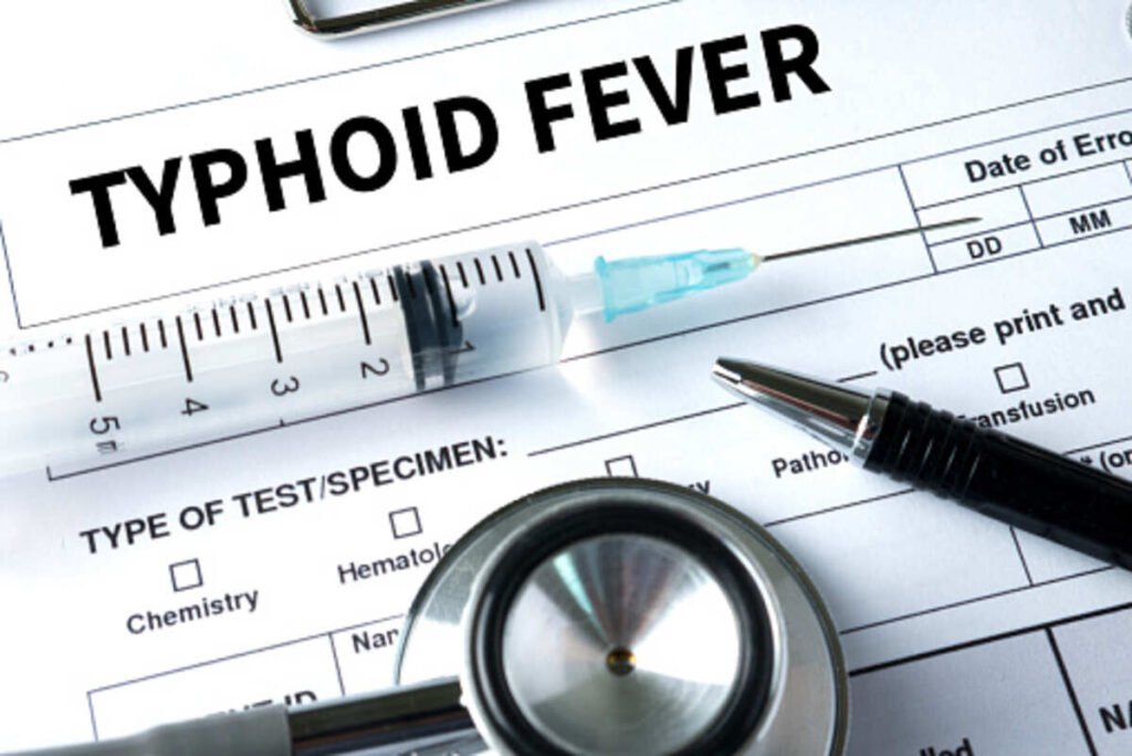 typhoid fever