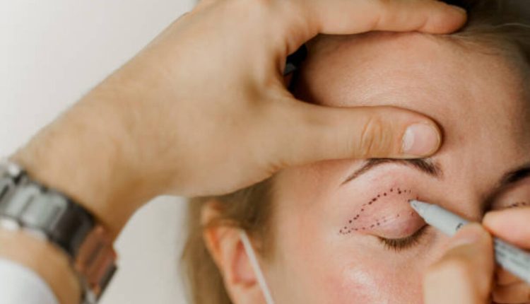 بلفاروپلاستی