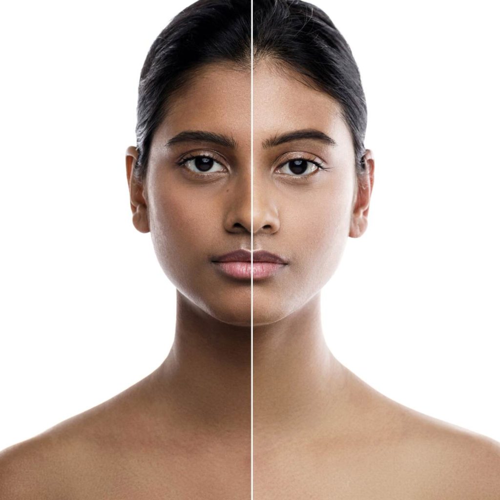 pigmentation treatments