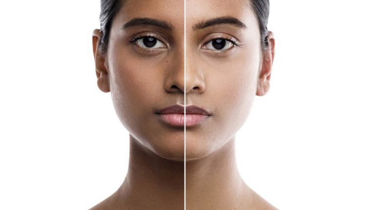 pigmentation treatments